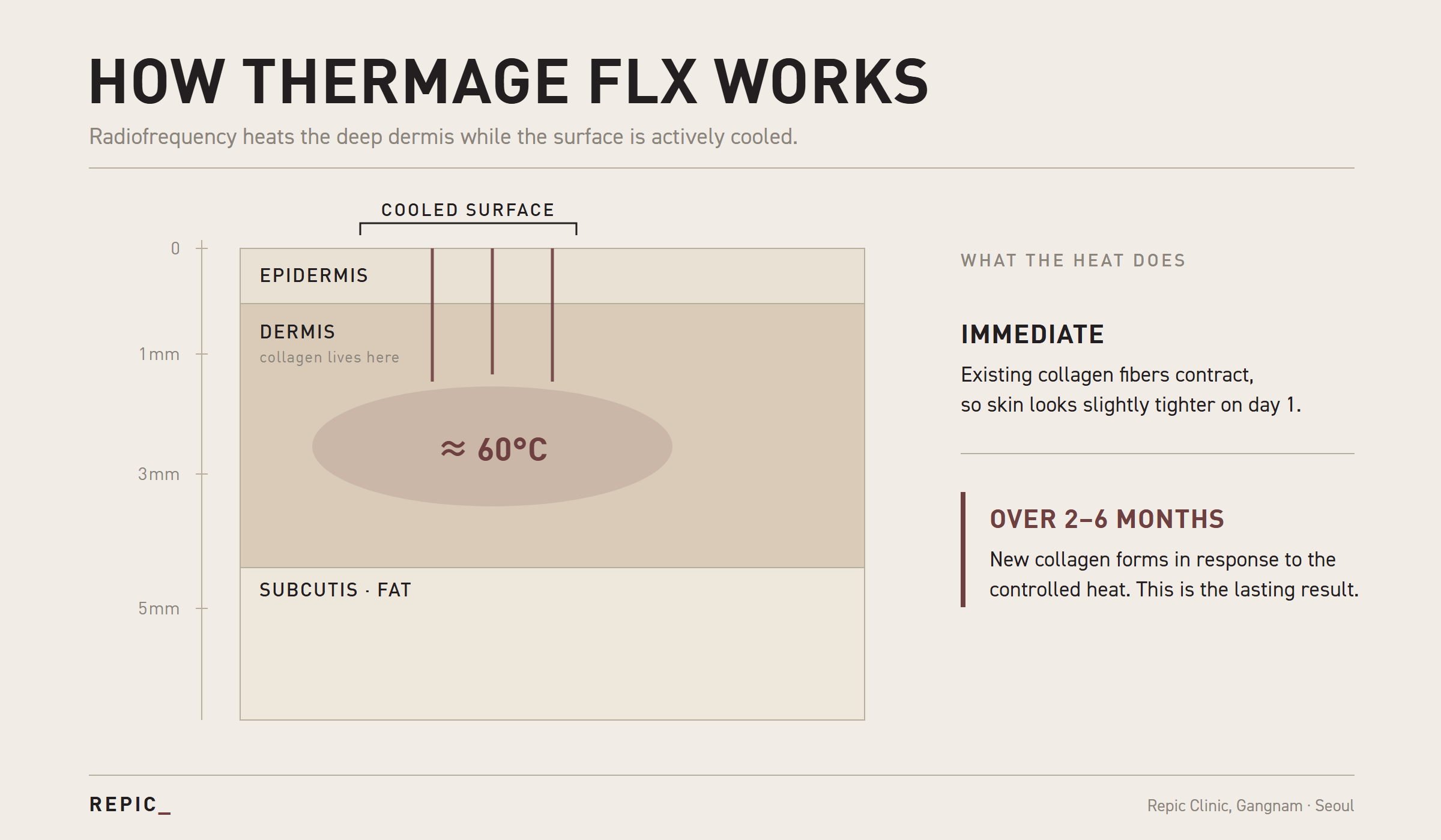 How Thermage FLX works cross-section diagram